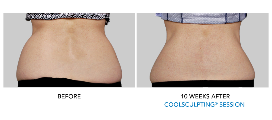 Freeze Fat Flower Mound - Before and After